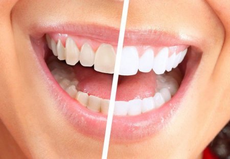Отбеливание зубов подручными средствами