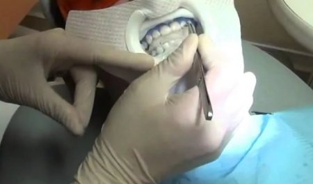 Некариозное поражение зубов - флюороз