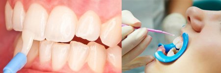 Что такое фторирование зубов? Плюсы и минусы