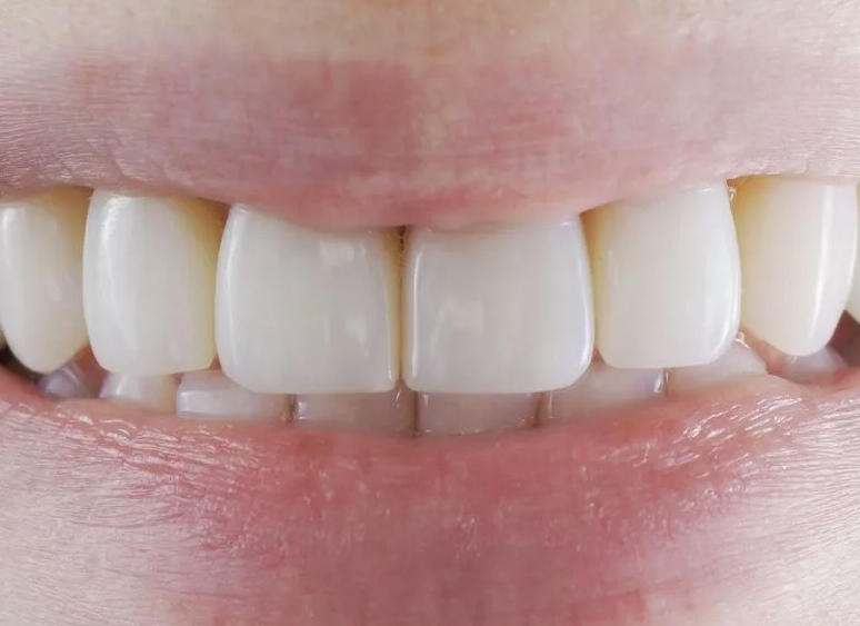 Зубная реставрация. Восстановление передних зубов. Реставрированные передние зубы. Восстановление зубов композитными материалами. Передние композитные зубы.