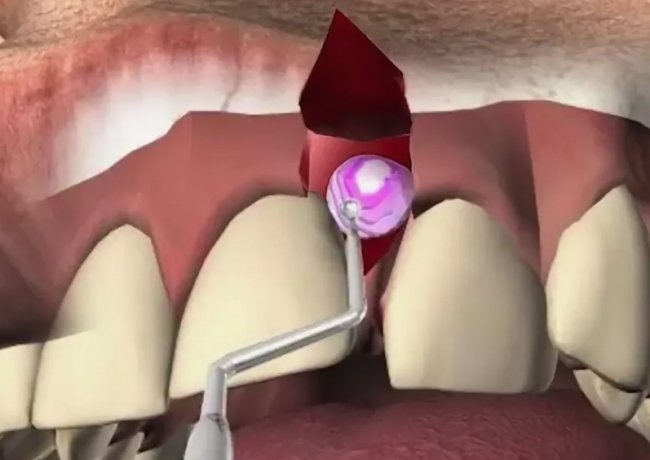 Консервативные и хирургические методы удаления кисты зуба