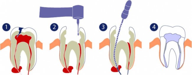Методы домашнего лечения кисты зуба