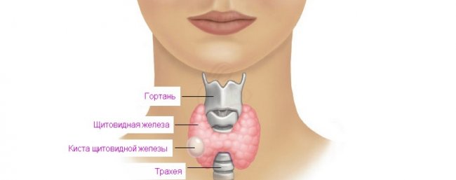 Коллоидная киста щитовидной железы: симптомы, причины, лечение