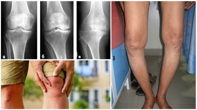 Консервативное лечение гонартроза (артроза коленного сустава)